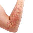 Skin rash caused by an allergic reaction